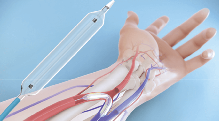 A.V. Shunt  Stenosis Dilatation Balloon Catheter