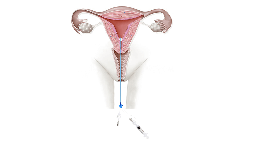 HSG Catheter